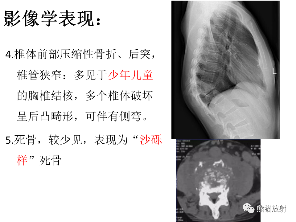 影像PPT - 【PPT】脊柱结核2例CT及MR影像-53