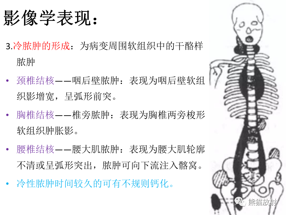 影像PPT - 【PPT】脊柱结核2例CT及MR影像-52