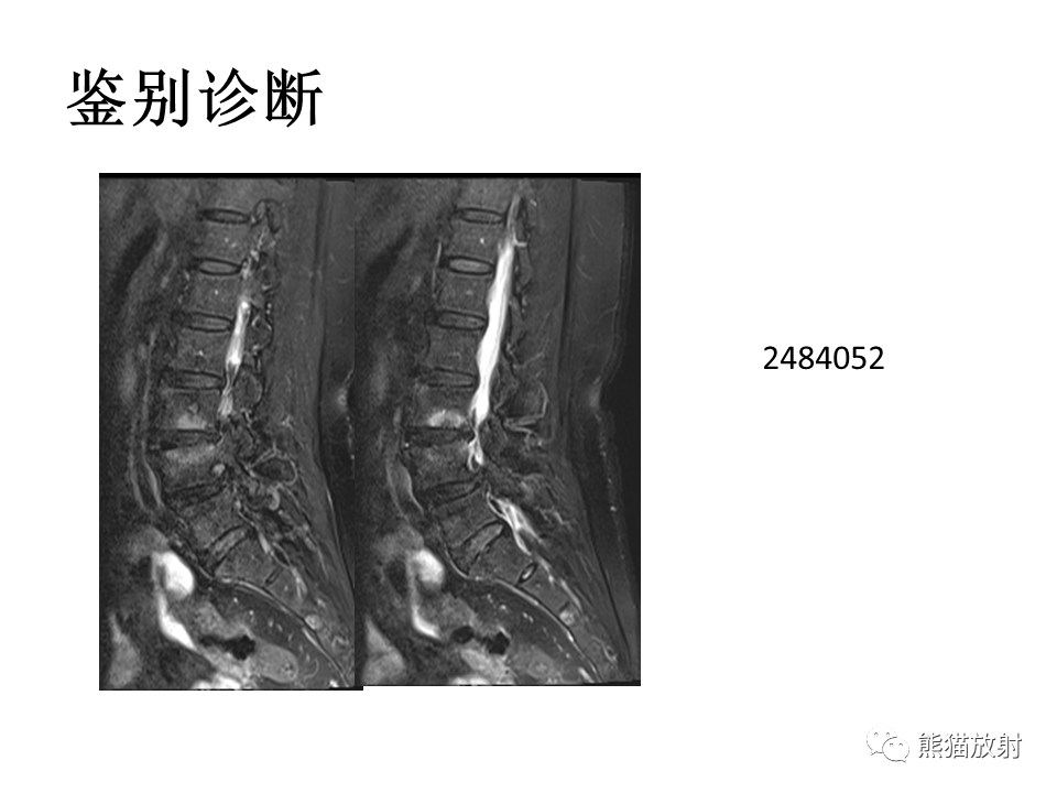影像PPT - 【PPT】脊柱结核2例CT及MR影像-59