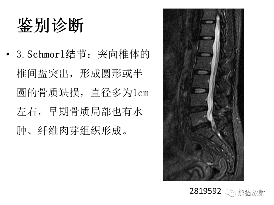 影像PPT - 【PPT】脊柱结核2例CT及MR影像-60