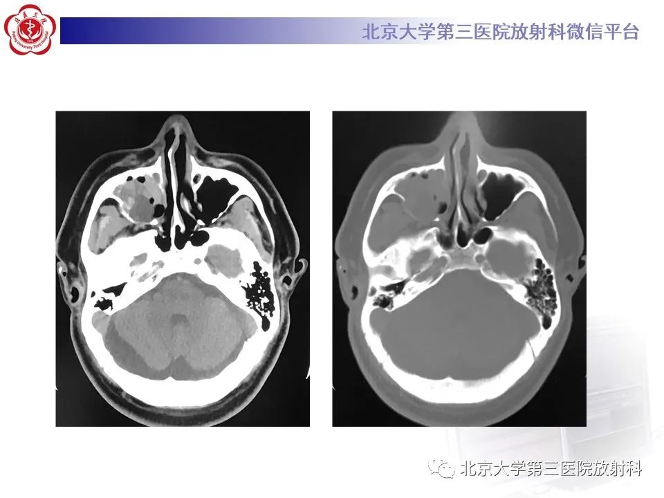 影像PPT - 【PPT】成釉细胞瘤-3