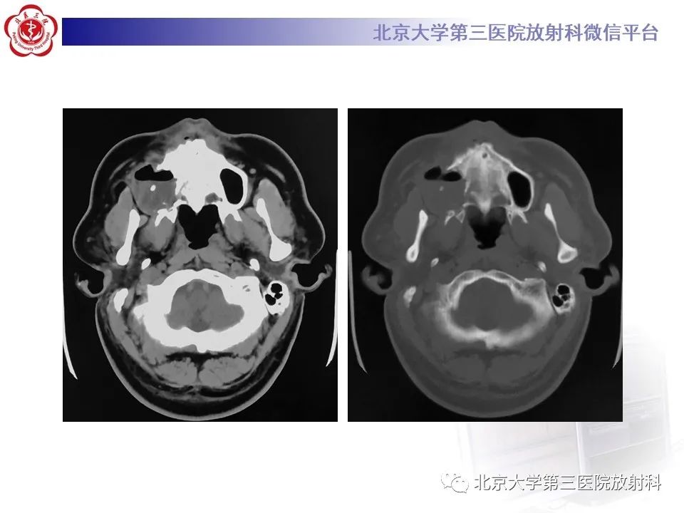 影像PPT - 【PPT】成釉细胞瘤-5