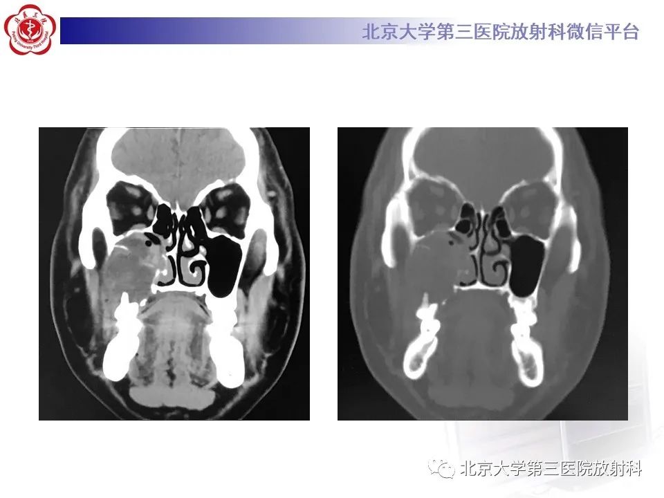 影像PPT - 【PPT】成釉细胞瘤-7