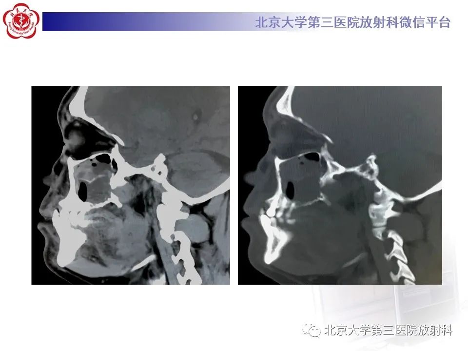 影像PPT - 【PPT】成釉细胞瘤-8