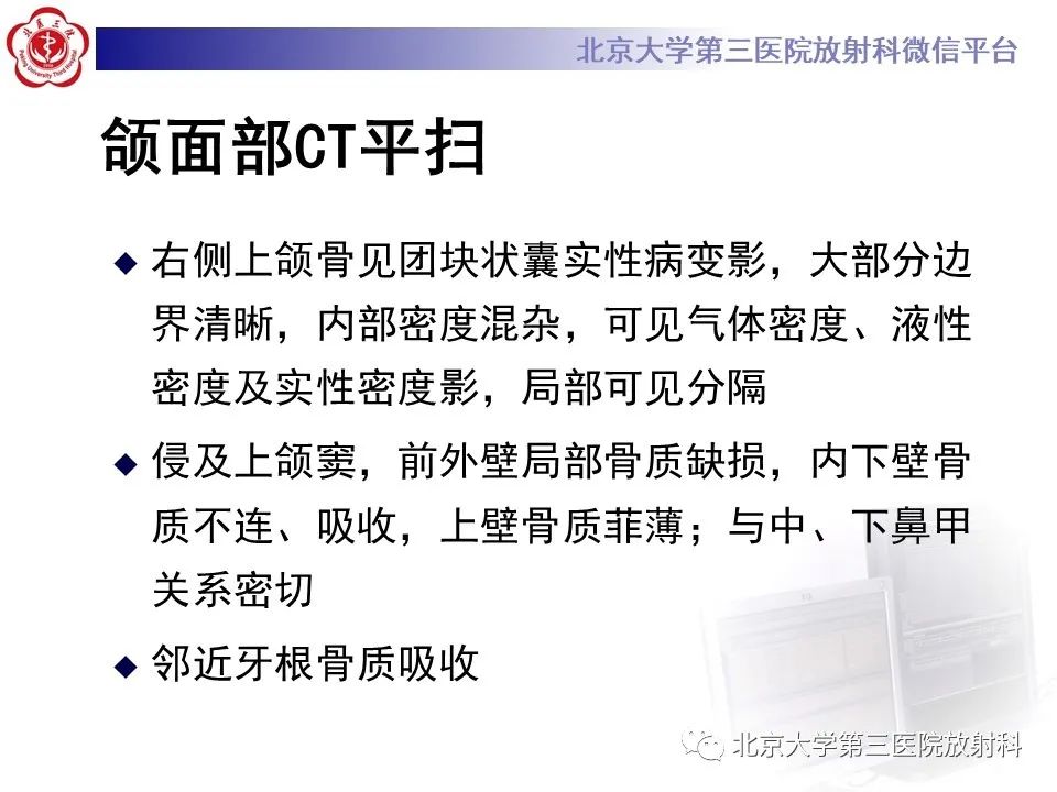 影像PPT - 【PPT】成釉细胞瘤-11