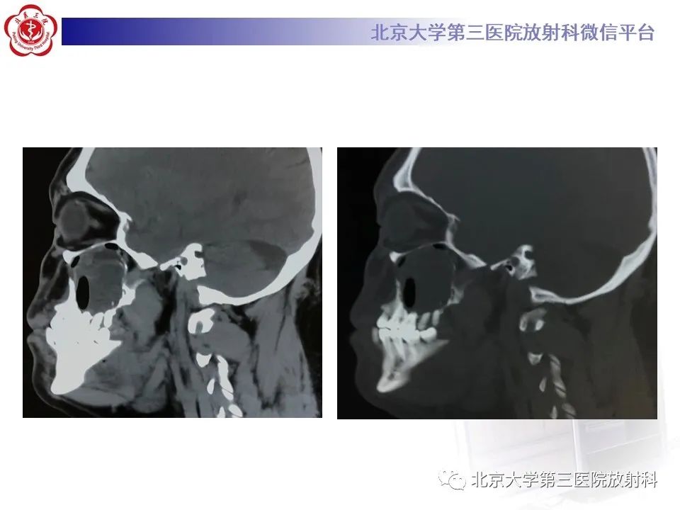 影像PPT - 【PPT】成釉细胞瘤-9