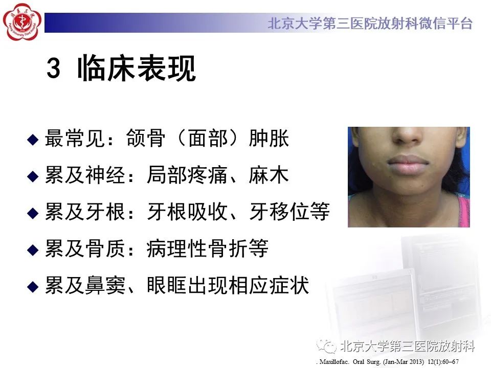 影像PPT - 【PPT】成釉细胞瘤-21