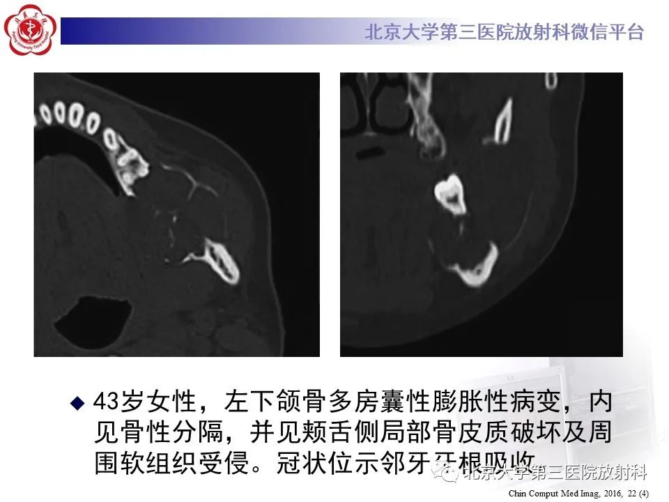 影像PPT - 【PPT】成釉细胞瘤-24