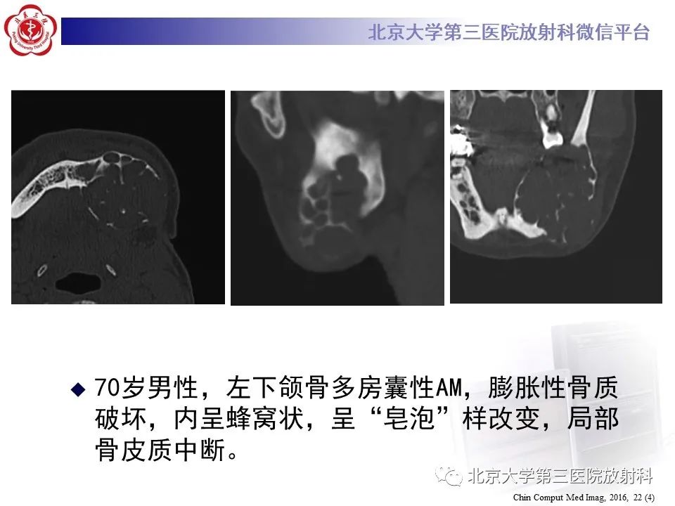 影像PPT - 【PPT】成釉细胞瘤-25