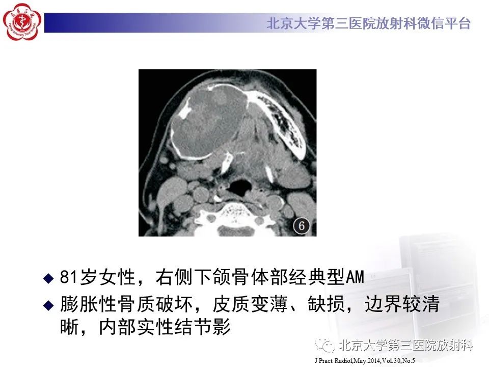影像PPT - 【PPT】成釉细胞瘤-26