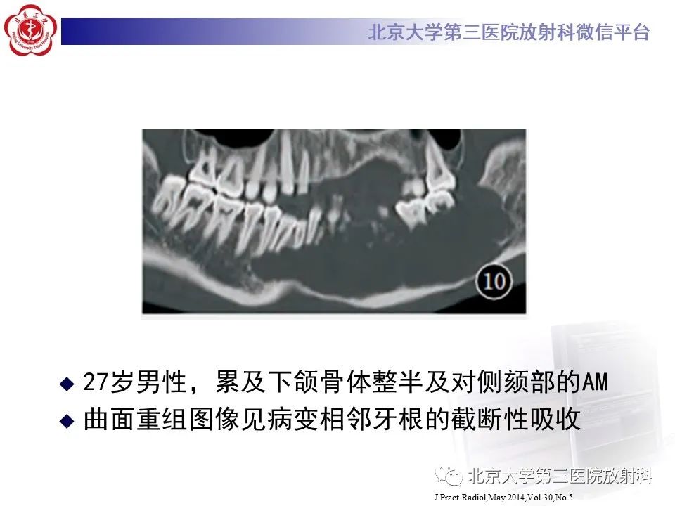 影像PPT - 【PPT】成釉细胞瘤-29