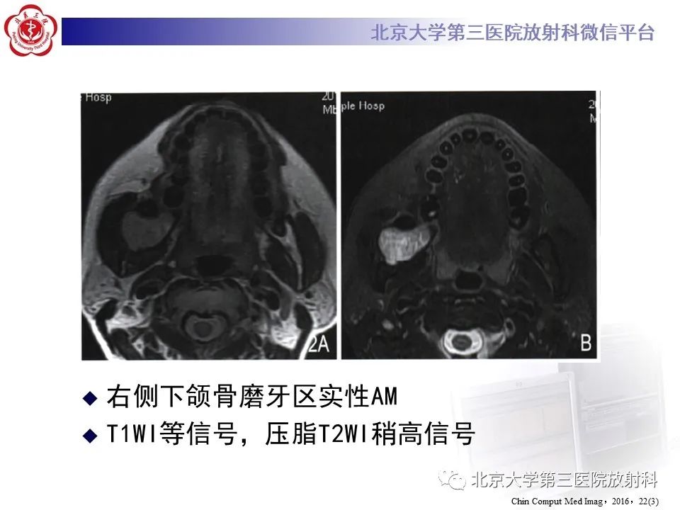 影像PPT - 【PPT】成釉细胞瘤-28
