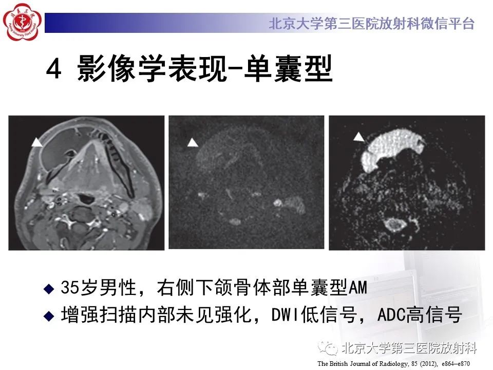 影像PPT - 【PPT】成釉细胞瘤-30