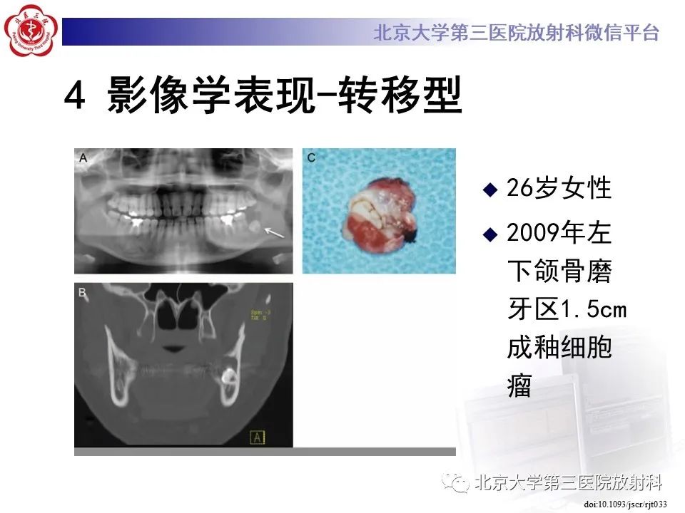 影像PPT - 【PPT】成釉细胞瘤-33