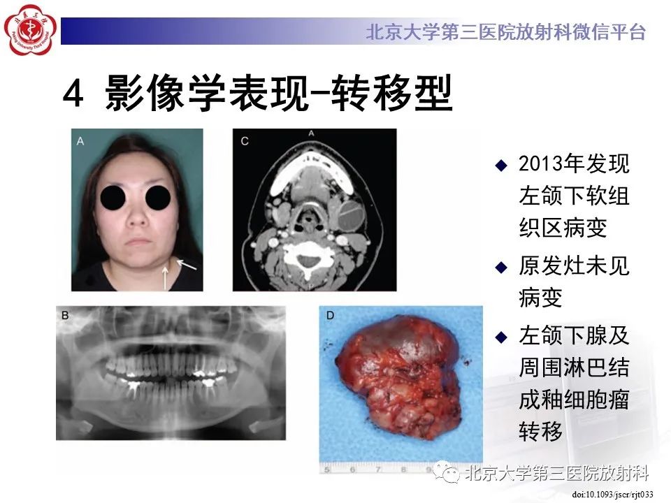 影像PPT - 【PPT】成釉细胞瘤-34