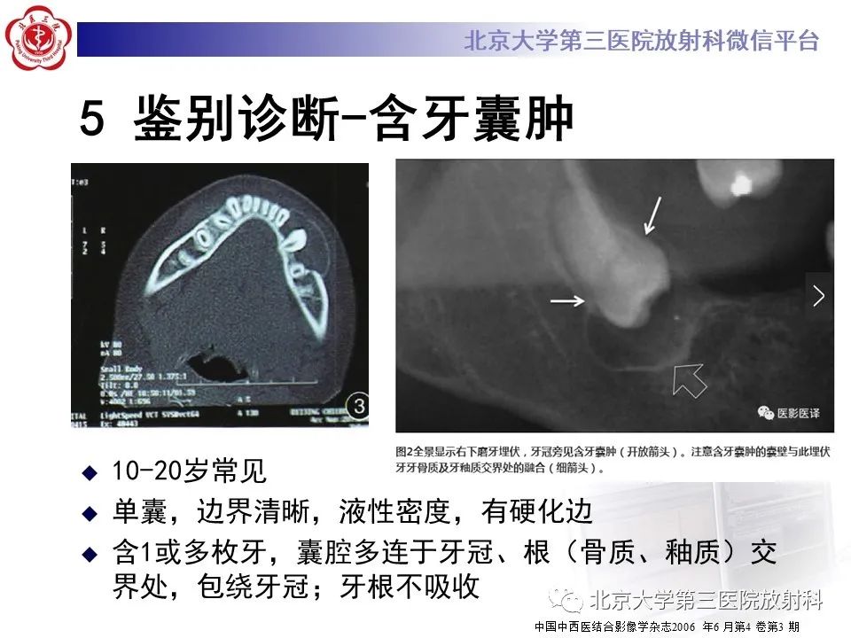 影像PPT - 【PPT】成釉细胞瘤-36