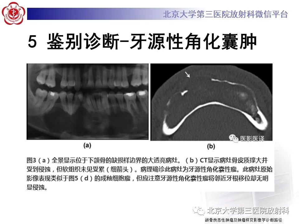 影像PPT - 【PPT】成釉细胞瘤-39