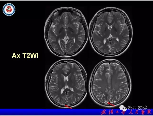 影像PPT - 【PPT】乳糜泻-癫痫-脑钙化综合征-5