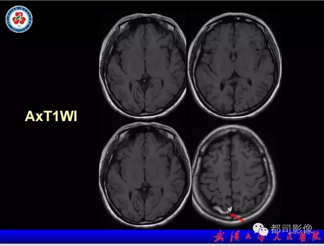 影像PPT - 【PPT】乳糜泻-癫痫-脑钙化综合征-4