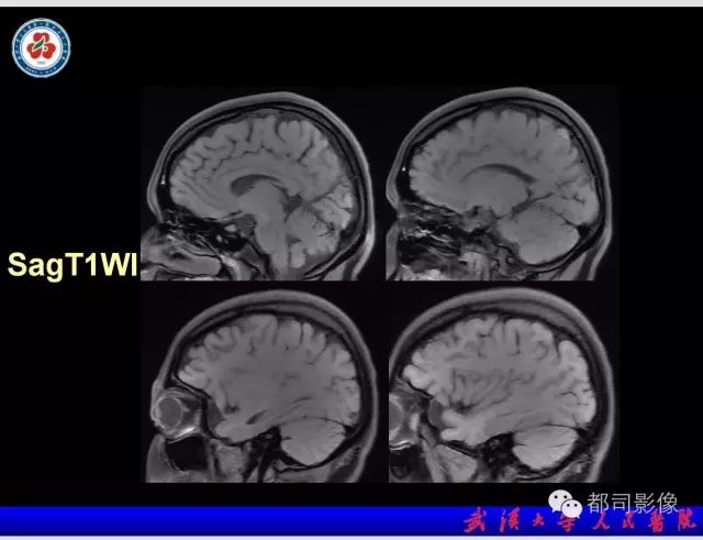 影像PPT - 【PPT】乳糜泻-癫痫-脑钙化综合征-7