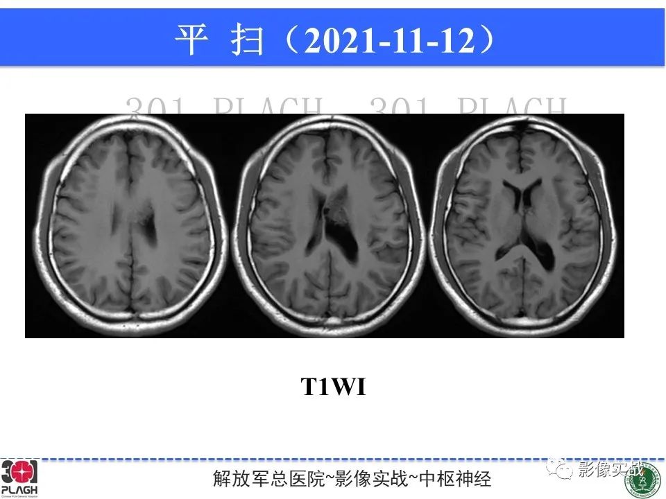 影像PPT - 【病例】中枢神经细胞瘤1例MR影像-6