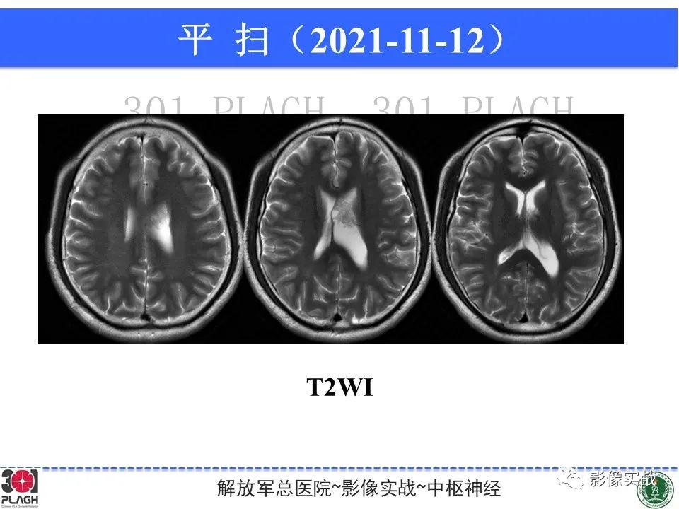 影像PPT - 【病例】中枢神经细胞瘤1例MR影像-5