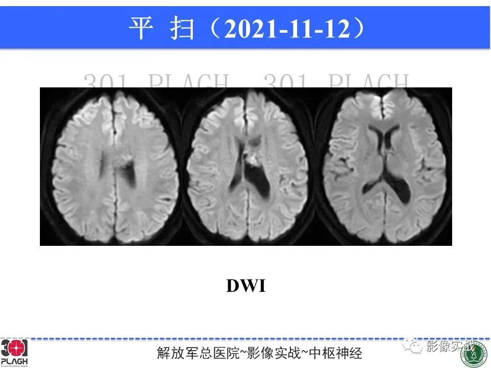 影像PPT - 【病例】中枢神经细胞瘤1例MR影像-7