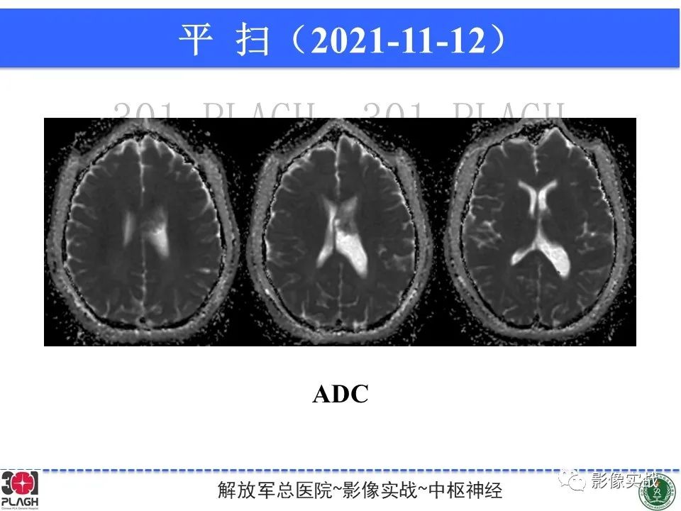 影像PPT - 【病例】中枢神经细胞瘤1例MR影像-8