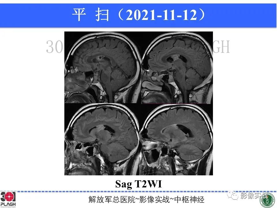 影像PPT - 【病例】中枢神经细胞瘤1例MR影像-10