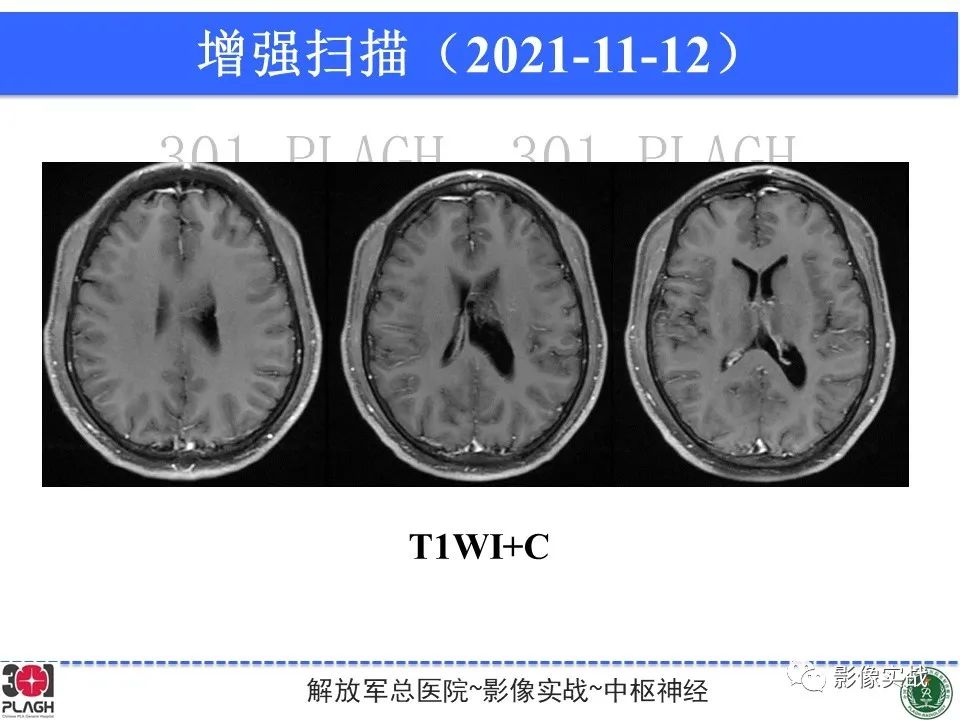 影像PPT - 【病例】中枢神经细胞瘤1例MR影像-11