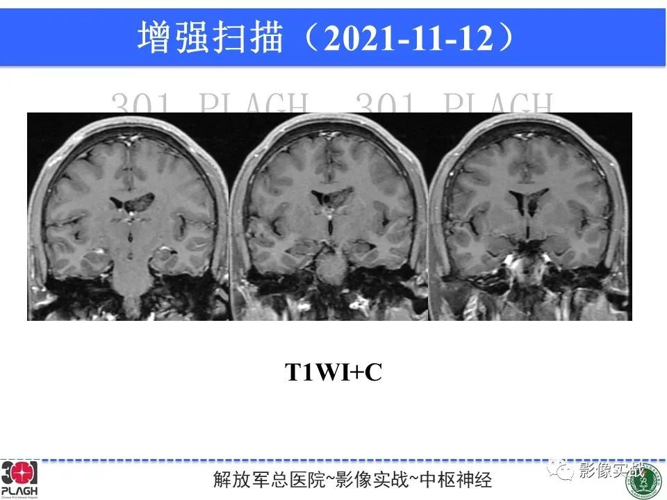 影像PPT - 【病例】中枢神经细胞瘤1例MR影像-12
