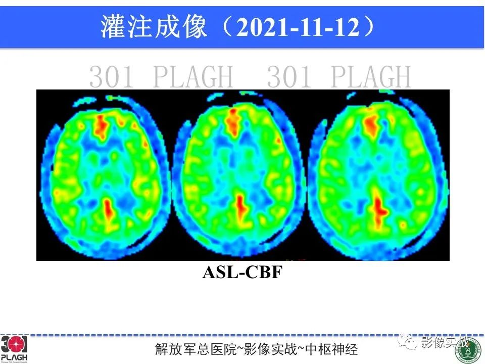 影像PPT - 【病例】中枢神经细胞瘤1例MR影像-14