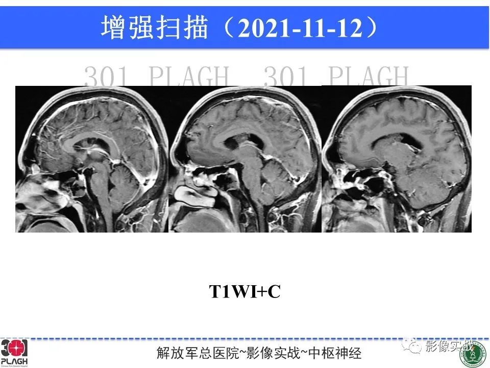 影像PPT - 【病例】中枢神经细胞瘤1例MR影像-13
