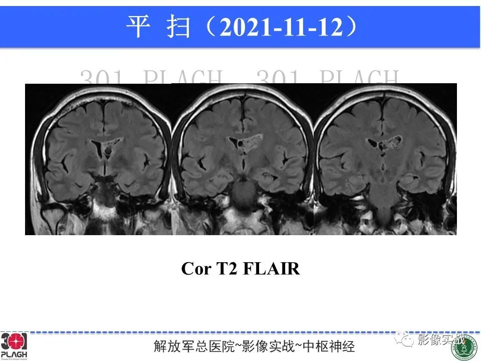 影像PPT - 【病例】中枢神经细胞瘤1例MR影像-9