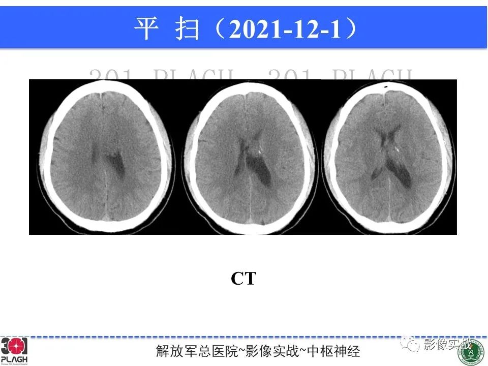 影像PPT - 【病例】中枢神经细胞瘤1例MR影像-16