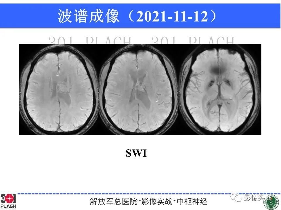 影像PPT - 【病例】中枢神经细胞瘤1例MR影像-15