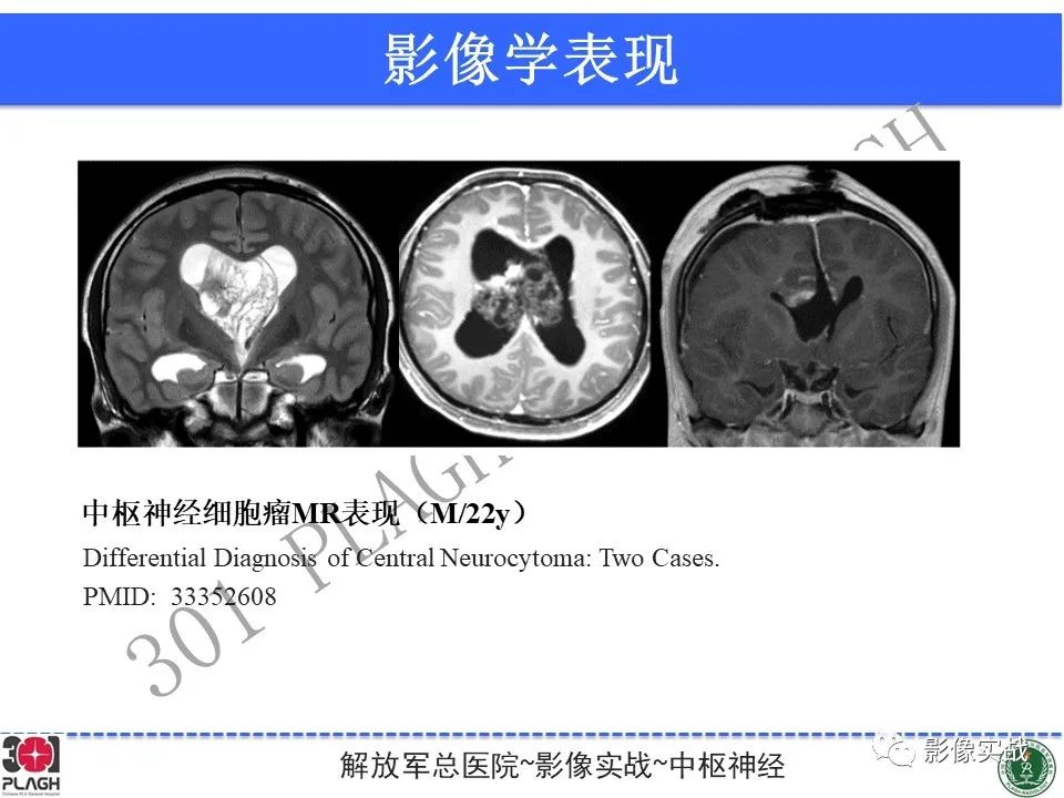 影像PPT - 【病例】中枢神经细胞瘤1例MR影像-28