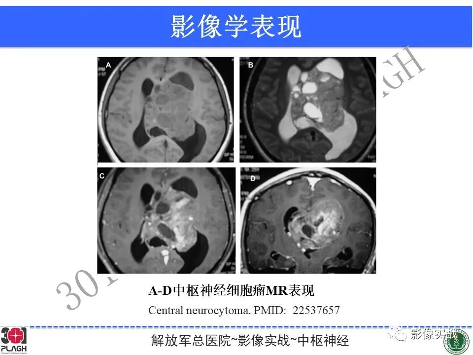 影像PPT - 【病例】中枢神经细胞瘤1例MR影像-29