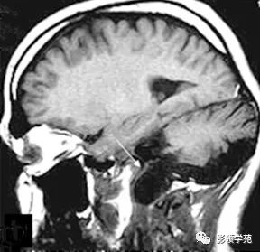 影像PPT - 【病例】颈静脉窝脑膜膨出1例MR-2 影像PPT - 【病例】颈静脉窝脑膜膨出1例MR-2