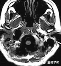 影像PPT - 【病例】颈静脉窝脑膜膨出1例MR-4 影像PPT - 【病例】颈静脉窝脑膜膨出1例MR-4