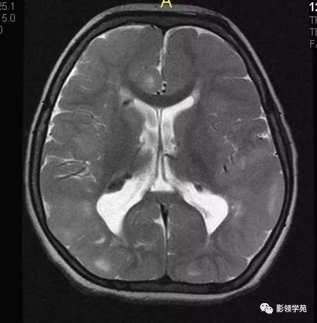 影像PPT - 结节性硬化影像表现-2 影像PPT - 结节性硬化影像表现-2