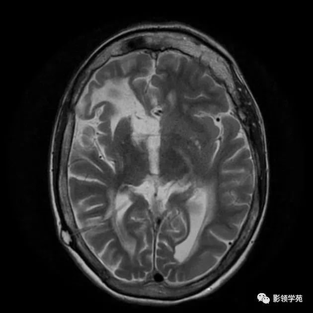 影像PPT - 结节性硬化影像表现-5 影像PPT - 结节性硬化影像表现-5