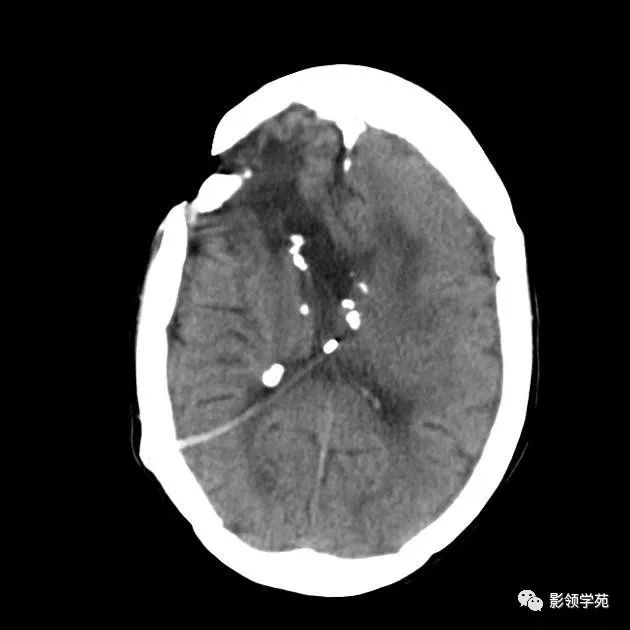 影像PPT - 结节性硬化影像表现-4 影像PPT - 结节性硬化影像表现-4