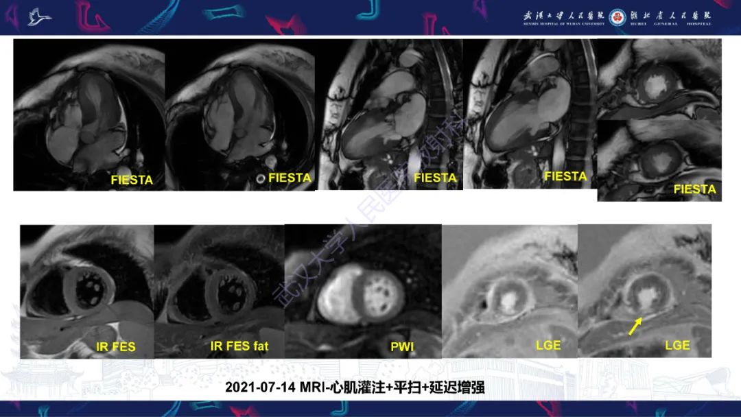 影像PPT - 【PPT】冠状动脉非阻塞性心肌梗死影像诊断-4