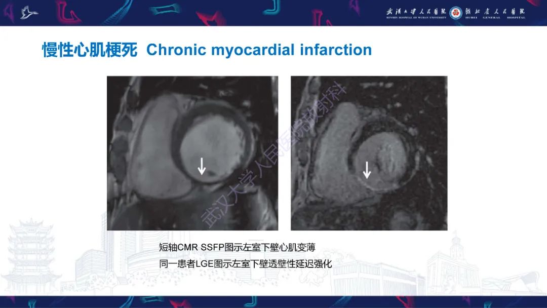 影像PPT - 【PPT】冠状动脉非阻塞性心肌梗死影像诊断-15