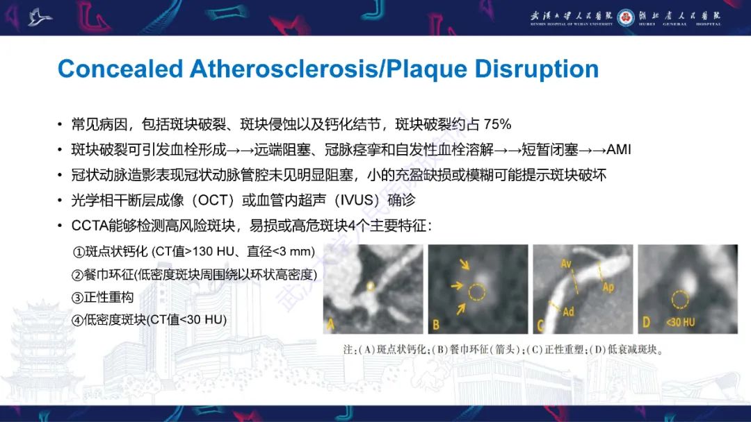 影像PPT - 【PPT】冠状动脉非阻塞性心肌梗死影像诊断-17