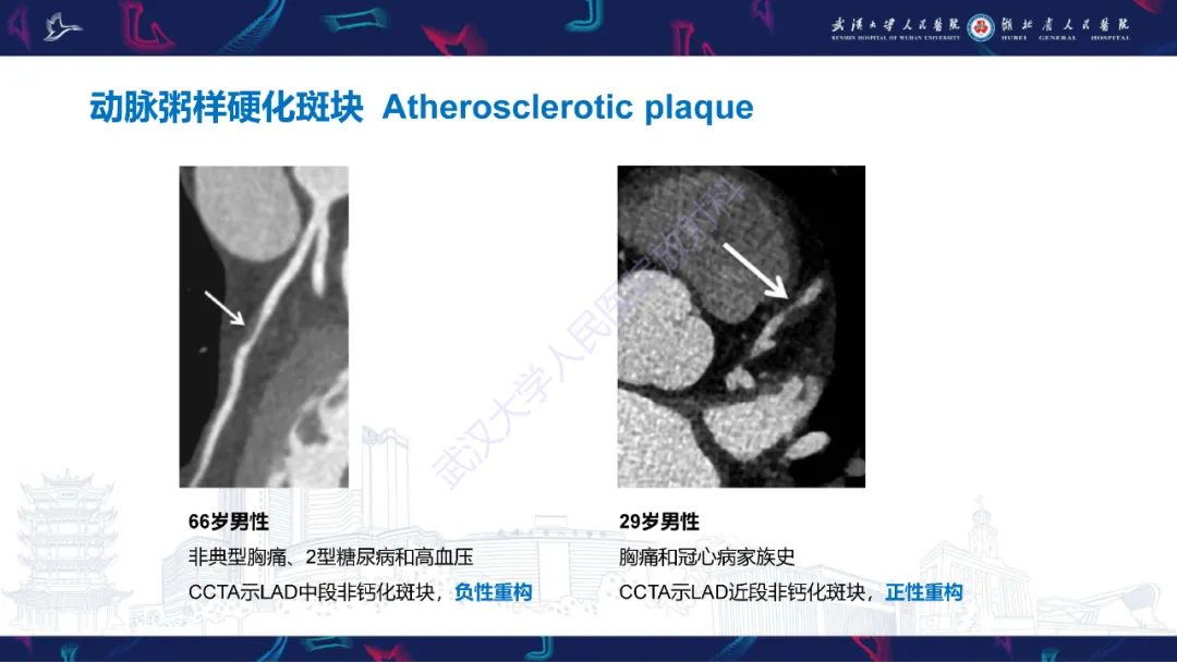 影像PPT - 【PPT】冠状动脉非阻塞性心肌梗死影像诊断-18