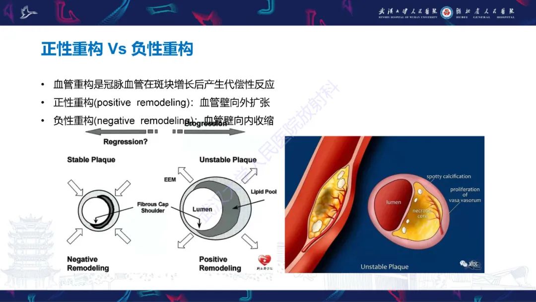 影像PPT - 【PPT】冠状动脉非阻塞性心肌梗死影像诊断-19