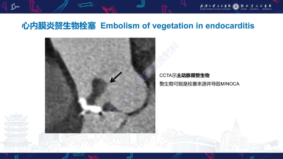影像PPT - 【PPT】冠状动脉非阻塞性心肌梗死影像诊断-24