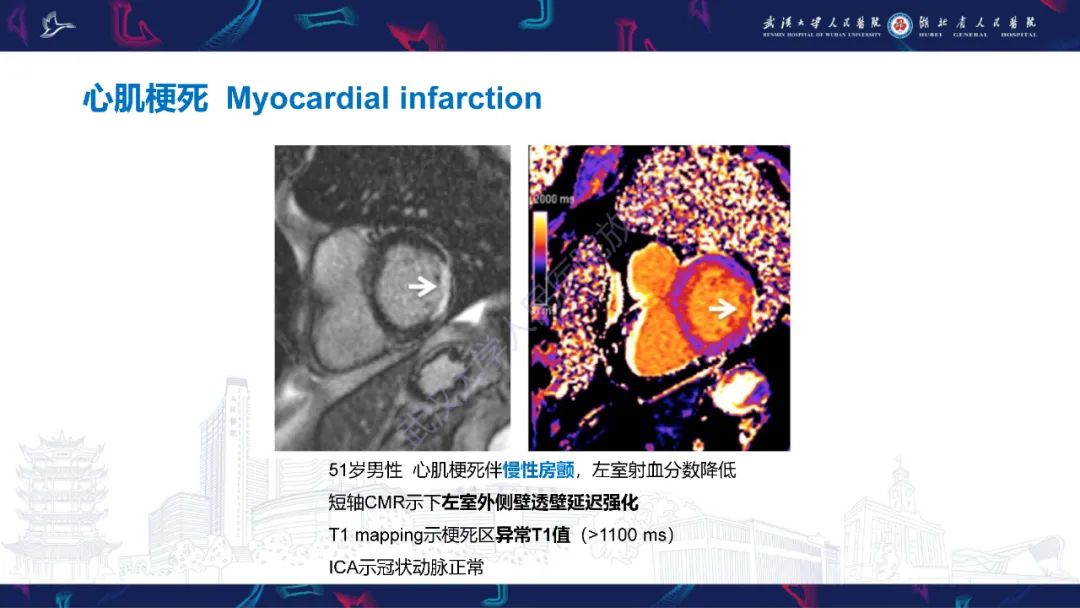 影像PPT - 【PPT】冠状动脉非阻塞性心肌梗死影像诊断-23